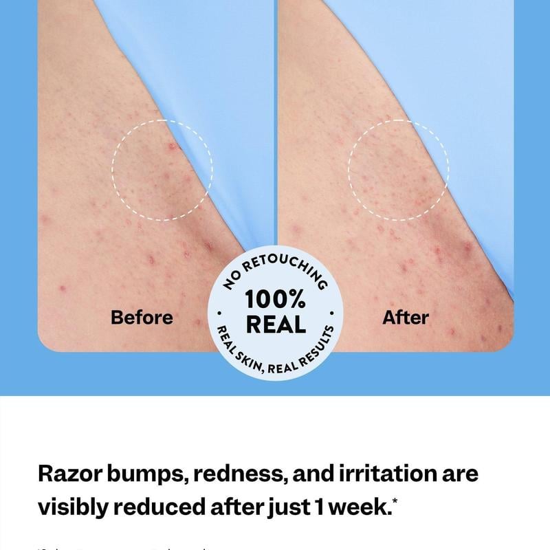 💝 Limited Time 49% OFF 🎇Peach Slices Smoothing Solution Ingrown Hair Treatmen