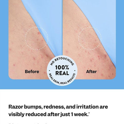 💝 Limited Time 49% OFF 🎇Peach Slices Smoothing Solution Ingrown Hair Treatmen